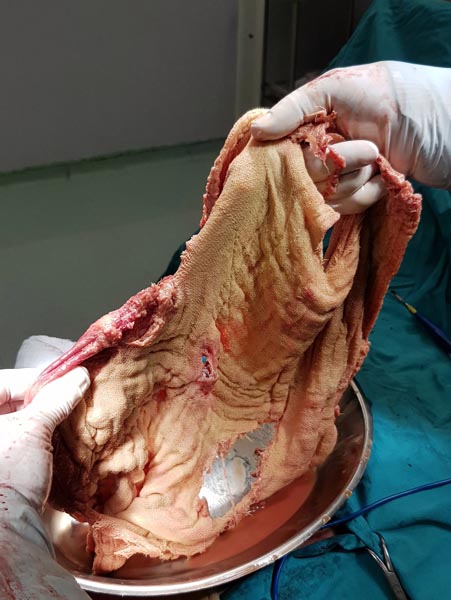 Kanser Diye Amaliyata Girdi İçinden Gazlı Bez Çıktı!