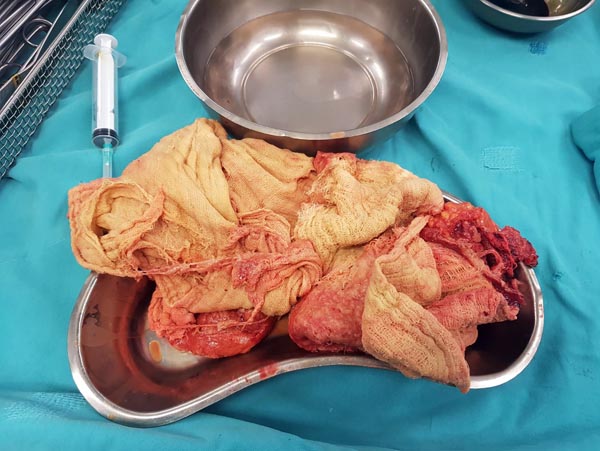 Kanser Diye Amaliyata Girdi İçinden Gazlı Bez Çıktı!