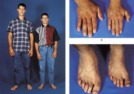 Akromegali nedir? Belirtileri nelerdir?