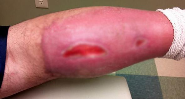 Et Yiyen Bakteri nedir | Zararı nedir Tedavisi var mı 