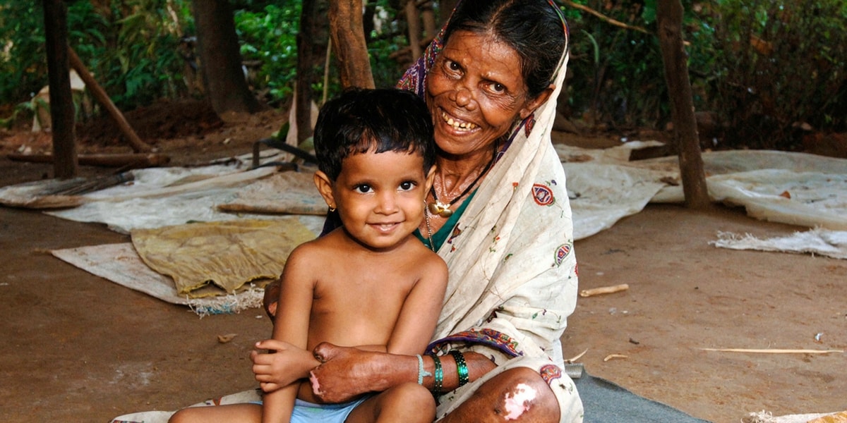 Cüzzam ( Lepra) nedir? tedavisi var mıdır? Cüzzamın belirtileri nelerdir? Nasıl bulaşır?