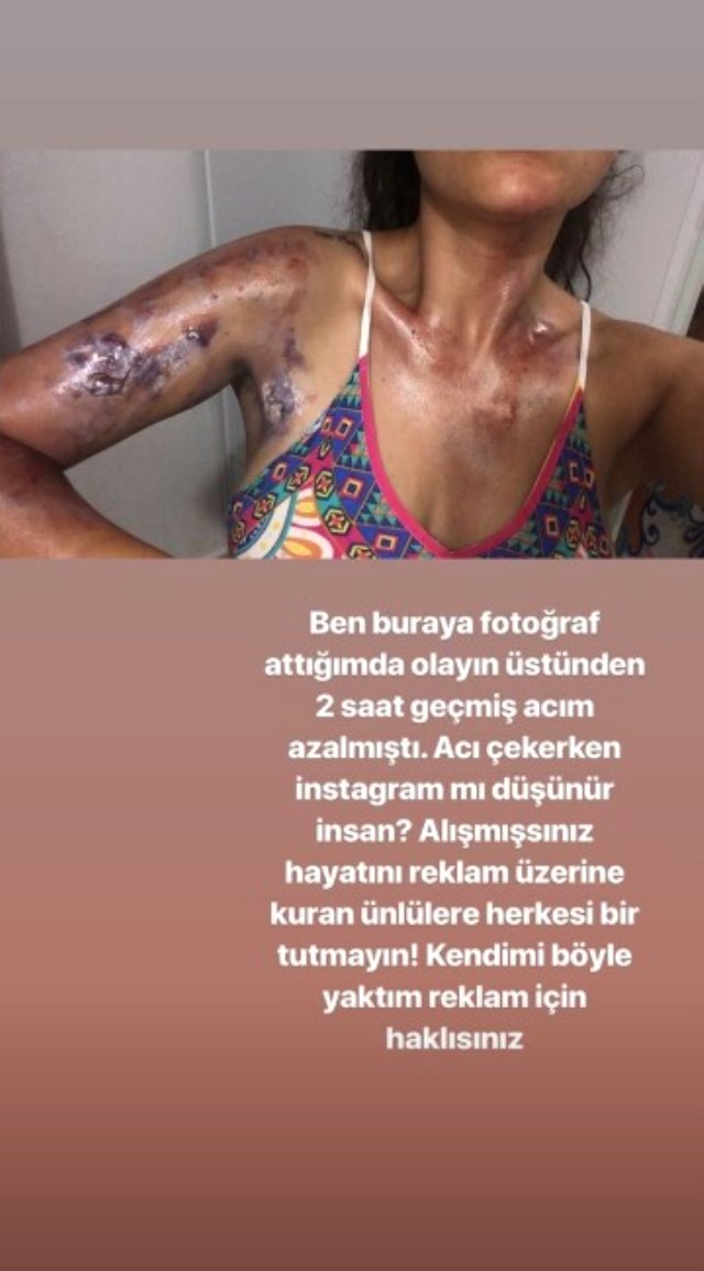 Evinde düdüklü tencere patlayan Sinem Umaş'ın vücudu yandı.
