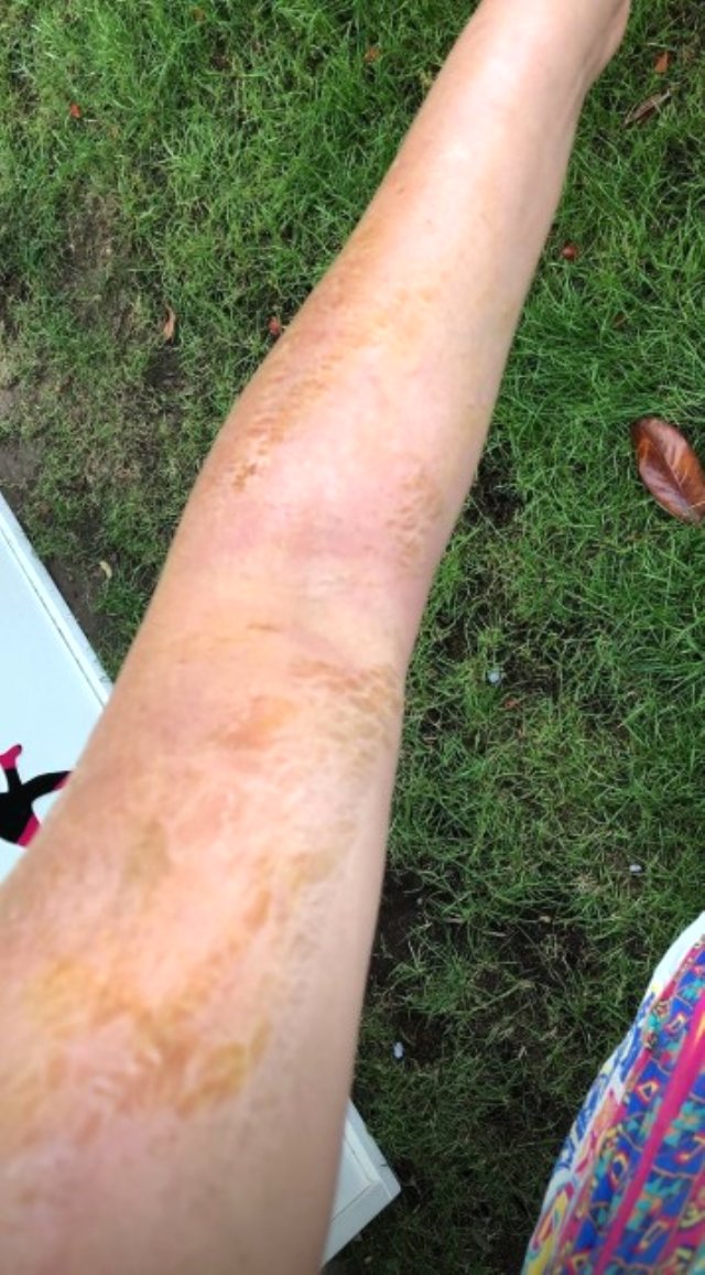 Evinde düdüklü tencere patlayan Sinem Umaş'ın vücudu yandı.