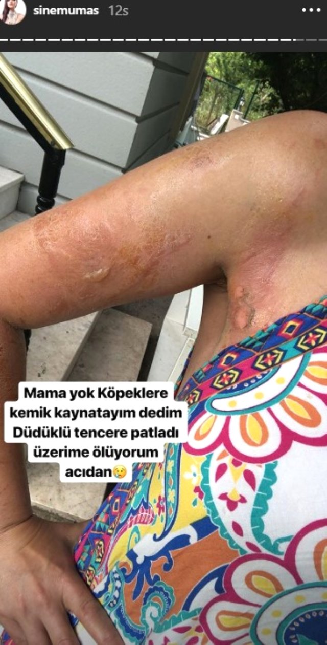 Evinde düdüklü tencere patlayan Sinem Umaş'ın vücudu yandı.