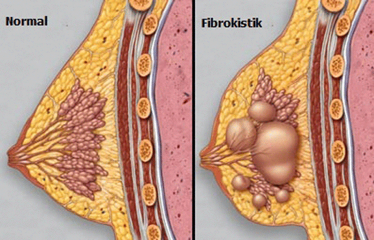 Memede Kist Nasıl Olur | Memede Kist Tedavisi Nasıl Olur