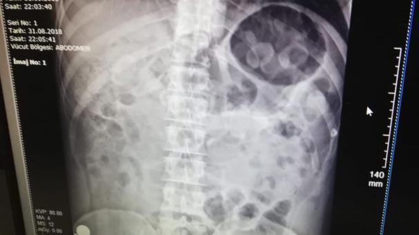 Midesinden 198 gram 30 kapsül uyuşturucu çıktı!