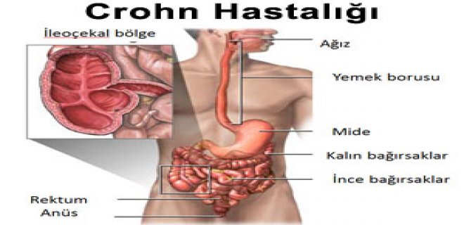 Crohn hastalığı nedir, belirtileri nelerdir? Neden olur?