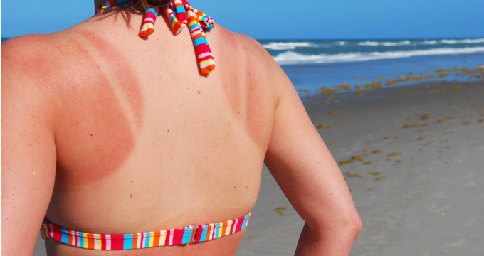 Güneş yanığına ne iyi gelir? Güneş yanığına doğal tavsiyeler