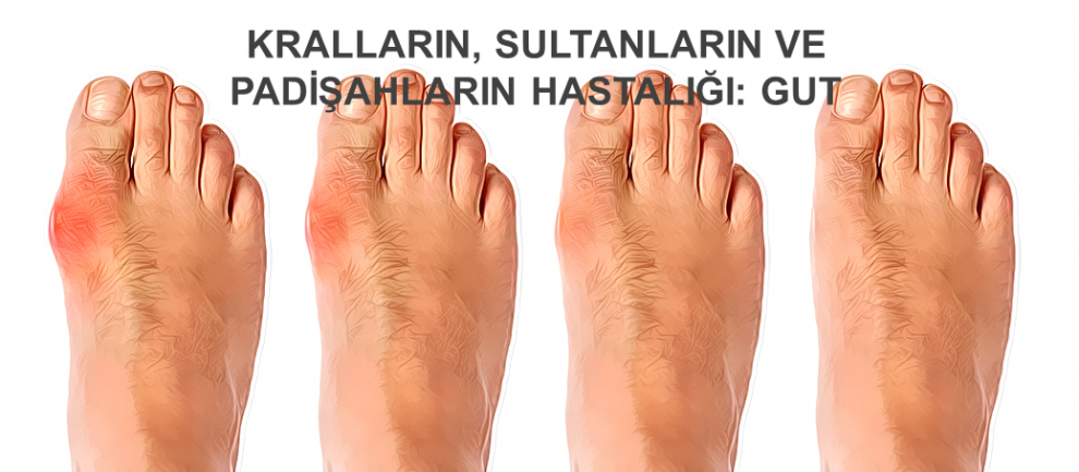 gut-hastaligindan-nasil-kurtulur.png Gut hastalığı görselleri