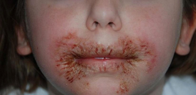 Islak mendil 8 yaşındaki kızın yüzünü yara içinde bıraktı!