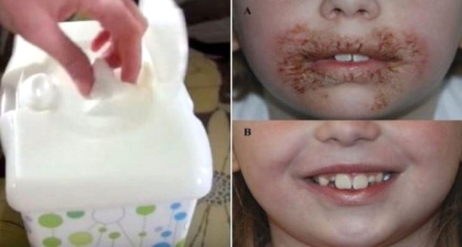 Islak mendil 8 yaşındaki kızın yüzünü yara içinde bıraktı!g