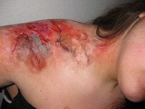 Et Yiyen Bakteri nedir | Zararı nedir Tedavisi var mı 