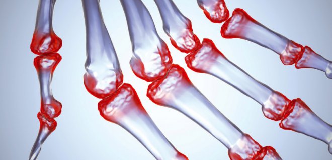 Osteomyelit (Kemik iltihabı) nedir? Neden olur, belirtileri nelerdir? Nasıl tedavi edilir?