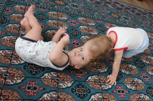 Kafaları yapışık siyam ikizleri 1 yaşına bastı!