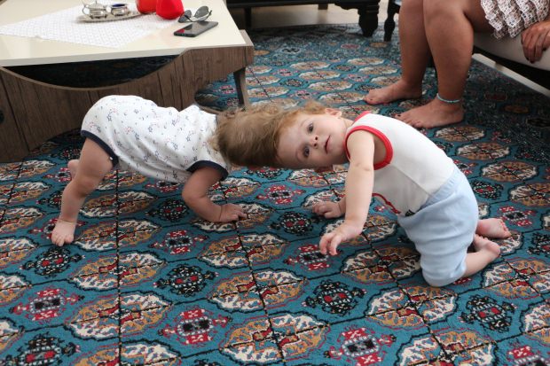 Kafaları yapışık siyam ikizleri 1 yaşına bastı!