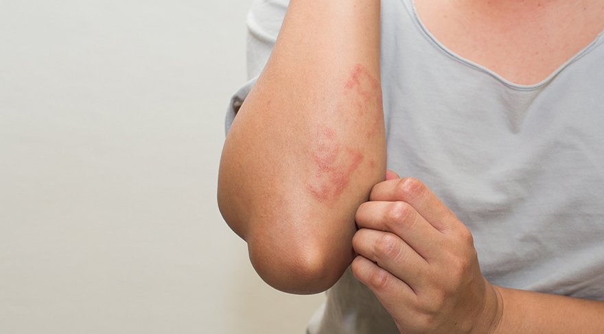 Ürtiker nedir? Neden olur? Ürtikerin belirtileri nelerdir? Tedavisi nasıl olur?