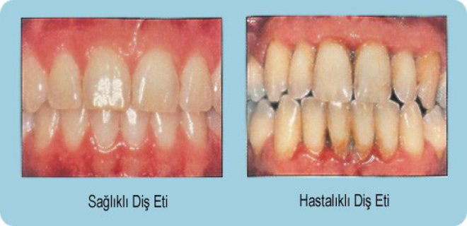 Diş küretajı nedir? Nasıl yapılır? Küretaj tedavisi yeterli midir?