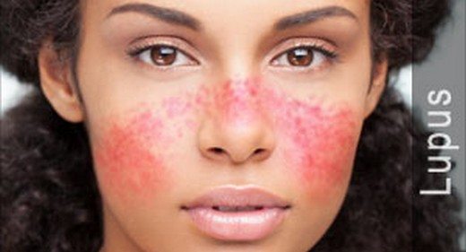 Lupus (SLE) nedir? Lupus hastalığı ölümcül müdür? Belirtileri nelerdir? Kimde görülür?