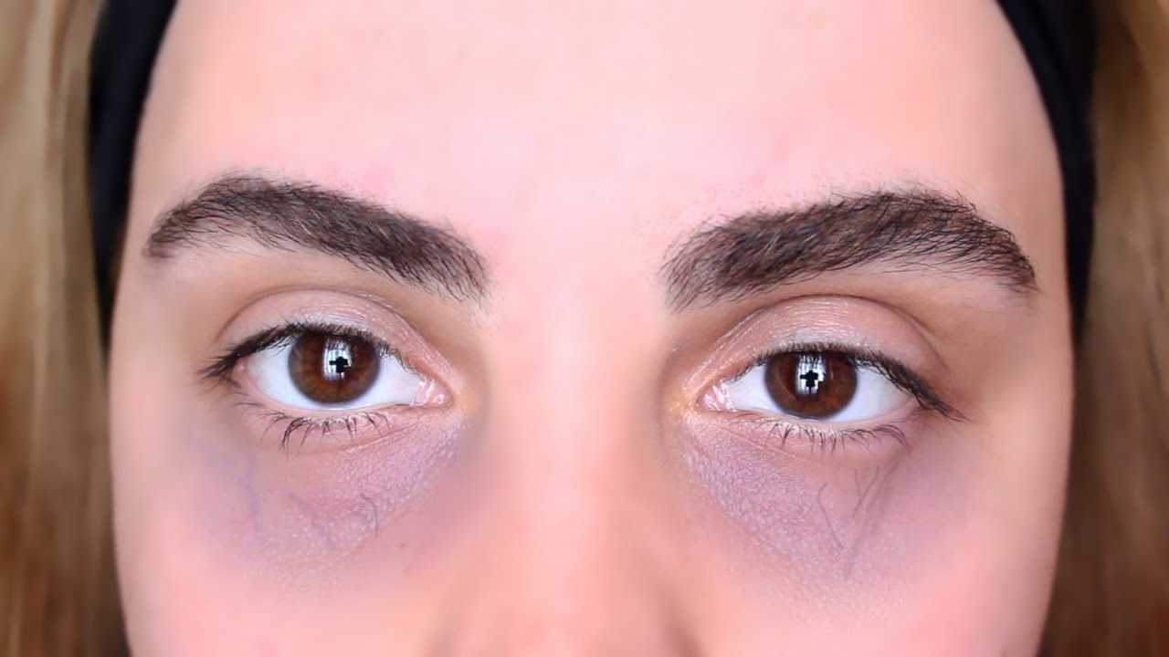 Göz altı morlukları neden olur, nasıl geçer? 