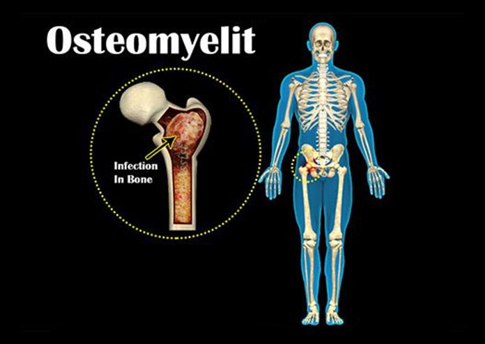Osteomyelit (Kemik iltihabı) nedir? Neden olur, belirtileri nelerdir? Nasıl tedavi edilir?