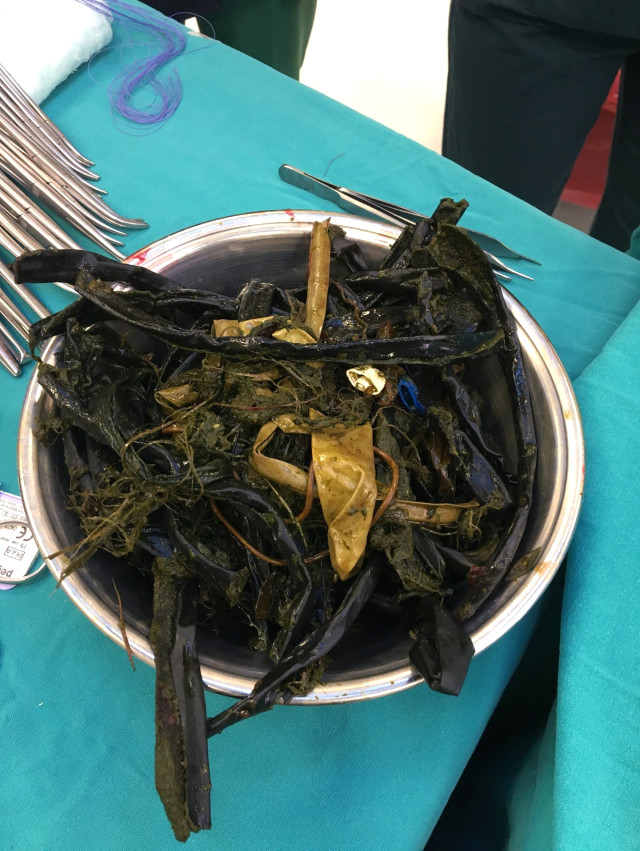 Otizmli çocuğun karnından çıkanlar pes dedirtti! 2 kilo çay kaşığı, kablo..