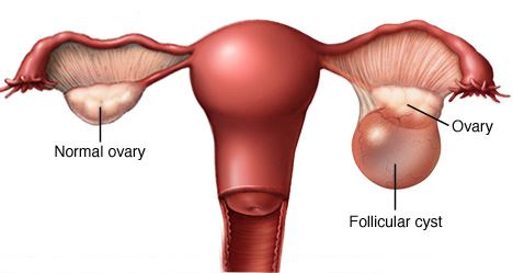 Kist Nedir | Dilay Çetinçay'ın Ölüm Sebebi Kist Nasıl Bir Hastalık