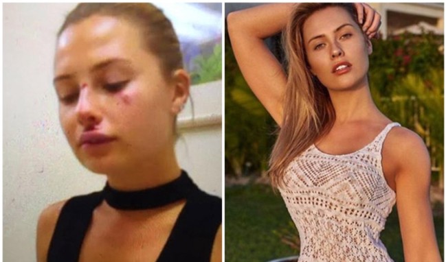 Kaza geçiren Serdar Ortaç'ın eşi Chloe tanınmaz hale geldi- Chole estetik mi yaptırdı