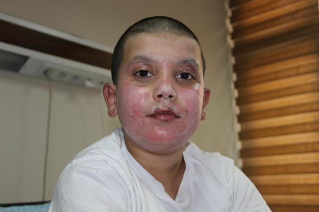 Sprey kutusu biranda patladı! Yüzü tamamen yandı...