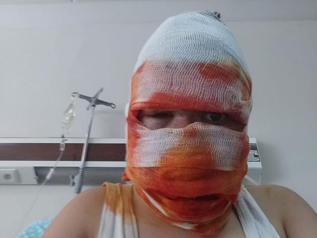 Sprey kutusu biranda patladı! Yüzü tamamen yandı...